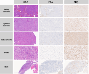 Folate Receptor Beta Found in Pediatric Tumors May Improve Fluorescence-Guided Cancer Surgery