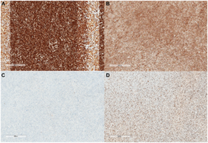 Rare Laryngeal Leiomyosarcoma Successfully Treated with Surgery and Adjuvant Chemotherapy